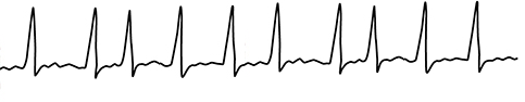Atrial fibrillation EKG