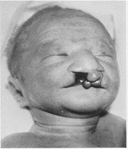 Baby with Patau's Syndrome
