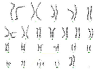 Down s Syndrome Trisomy 21 