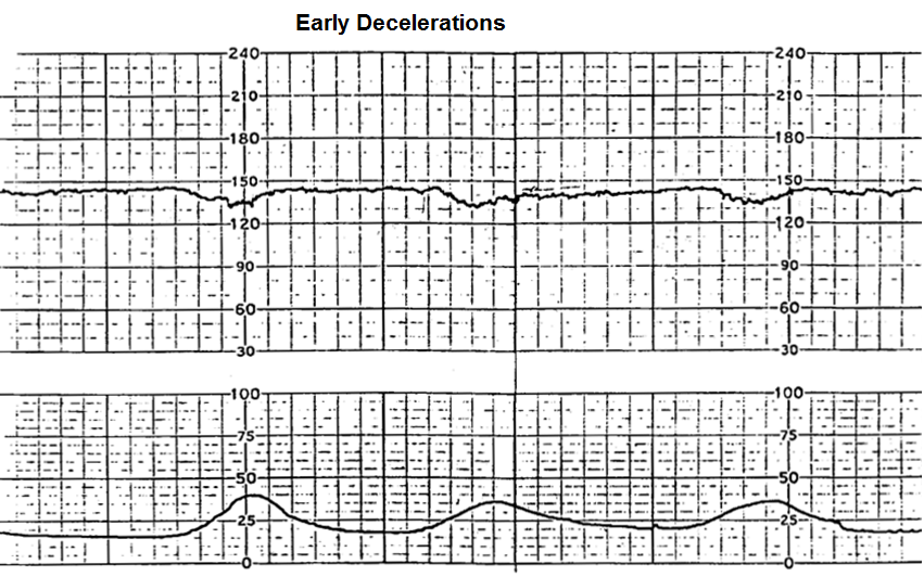 Early decelerations
