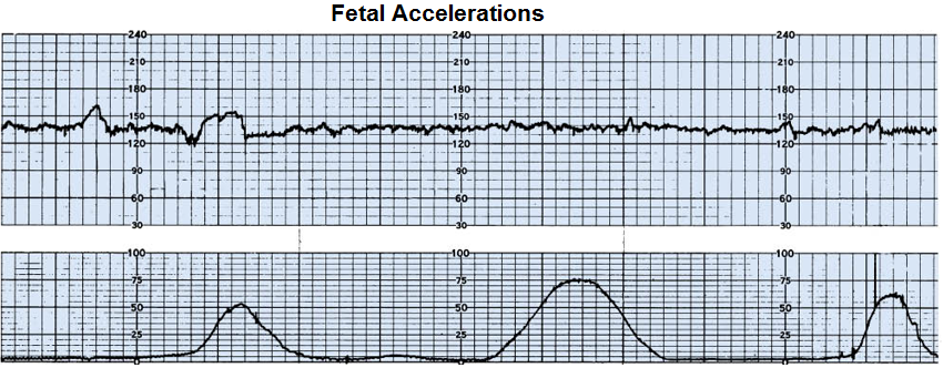 Fetal accelerations