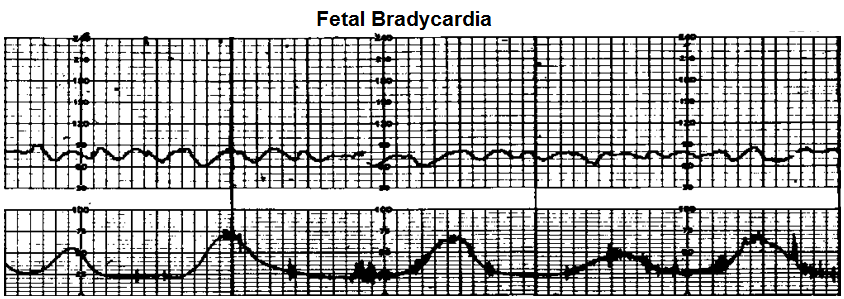 Fetal bradycardia