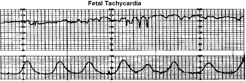 Fetal tachycardia
