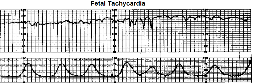 Tachycardia in fetus