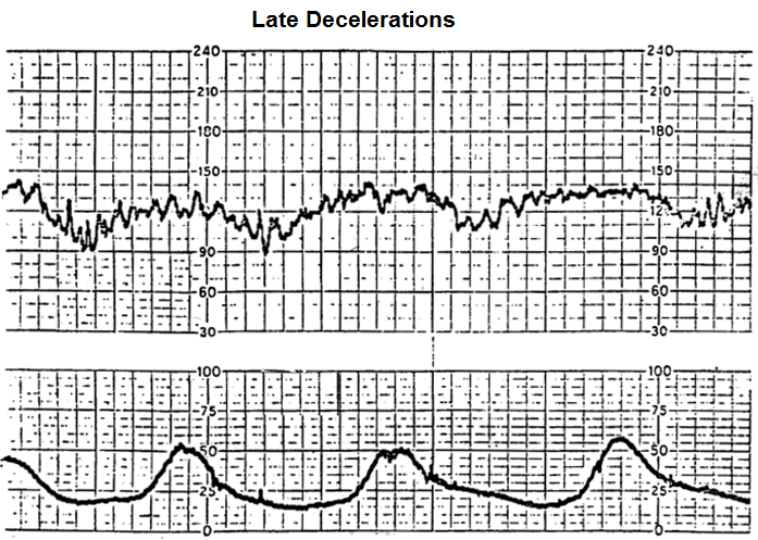 Late decelerations