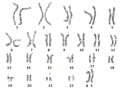 Of sex chromosomes in trisomy 18