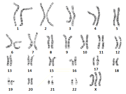 Superfemale XXX chromosomes