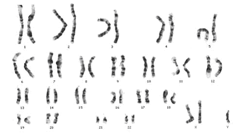 Klinefelter's syndrome (XXY) karyotype