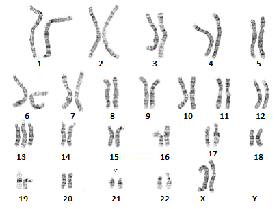 Patau's Syndrome- Trisomy 13 karyotype